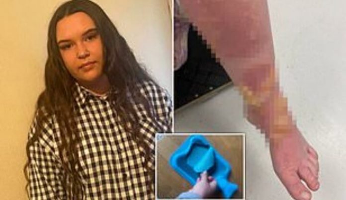 Hot water bottle EXPLODES leaving disabled teenager, 18, with third-degree burns 1