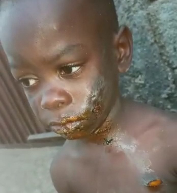 Boy Left With Serious Burns After He Was Physically Abused By His Aunt In Imo State