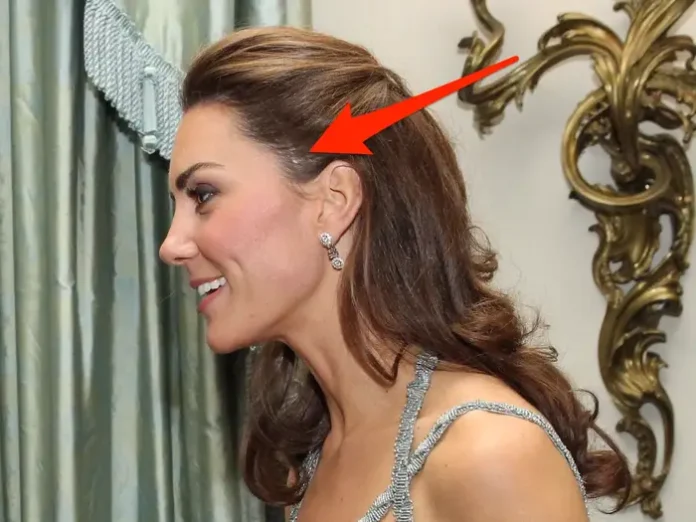 The Scar Under Kate's Brunette Locks And William's 'Harry Potter Scar'