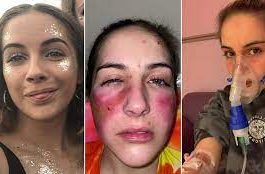 Woman Who Is So 'Allergic To Herself' Her Skin Breaks Out In Welts If She Laughs Or Cries Is Dubbed A Medical Mystery By Doctors Who Haven't Been Able To Diagnose Her In Five Years