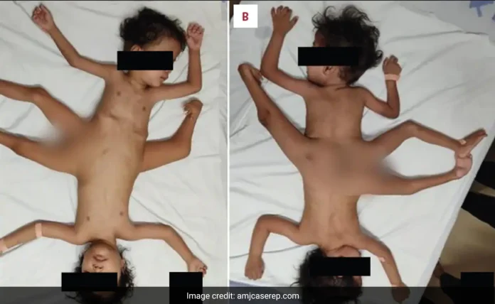 Exceptionally Uncommon 'Spider Twins' Possess Three Legs, Four Arms, And A Singular Genital Organ