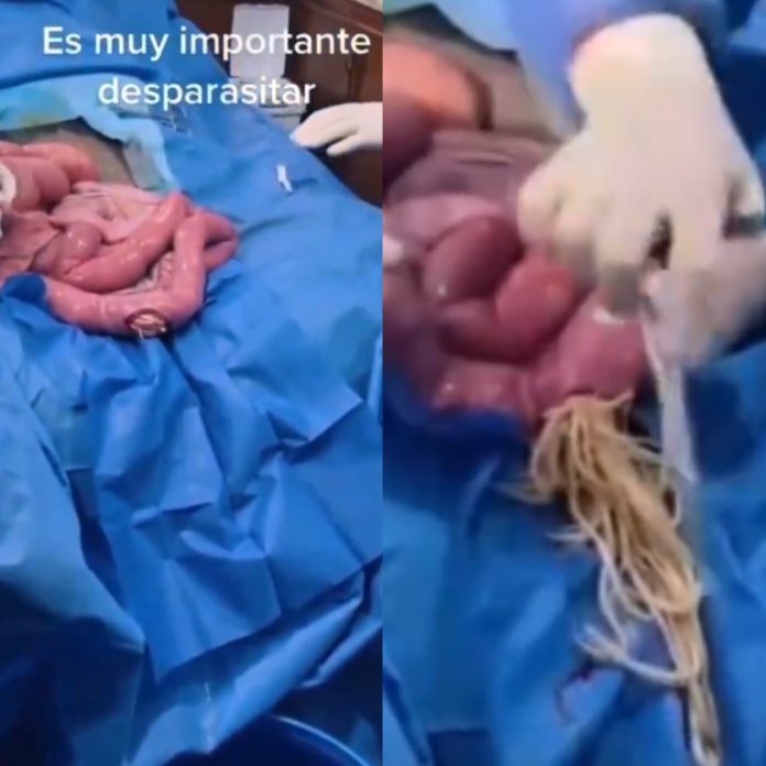 Video: Doctors Remove Hundreds Of Parasitic Worms From A Human Intestine